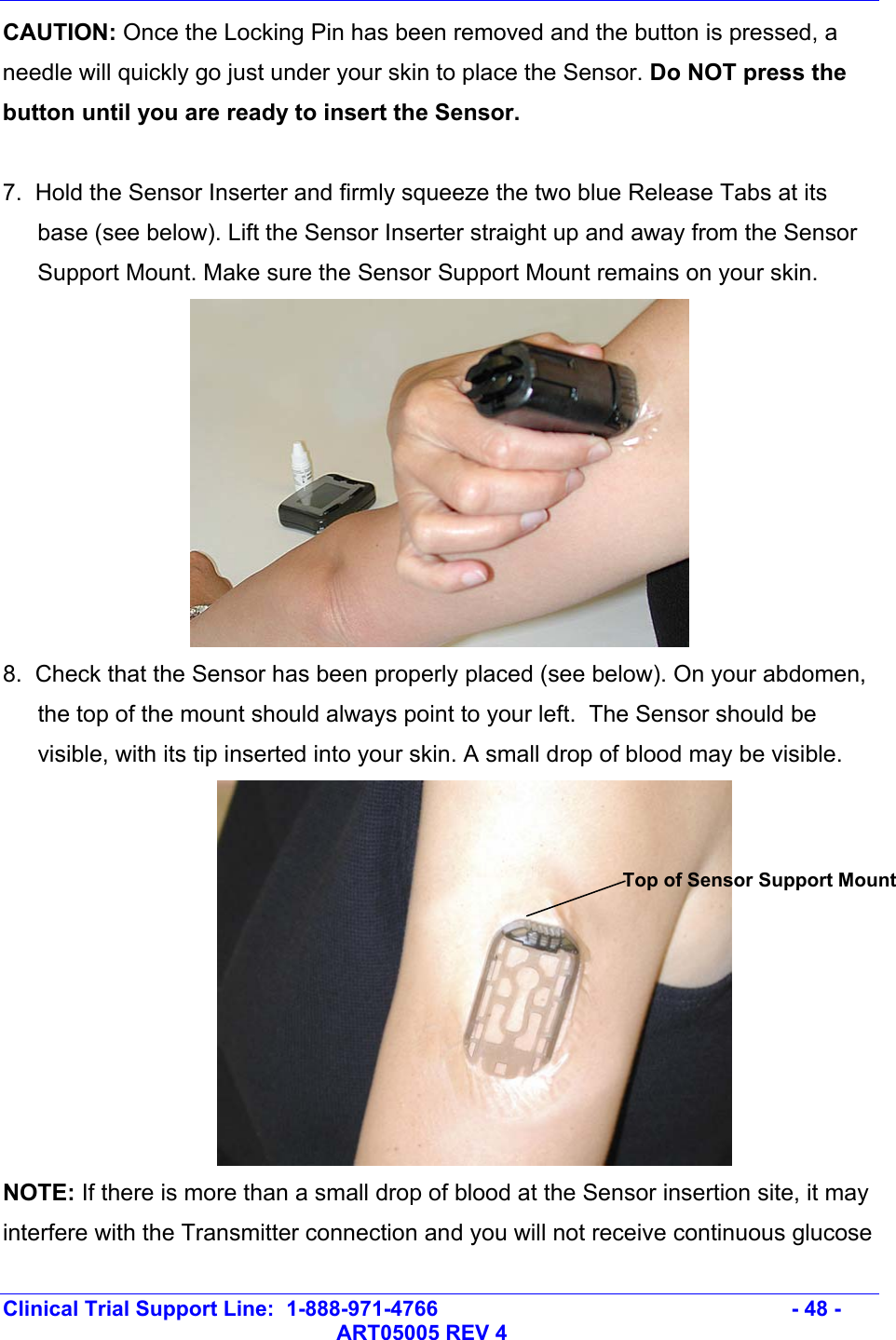   Clinical Trial Support Line:  1-888-971-4766   - 48 -   ART05005 REV 4 CAUTION: Once the Locking Pin has been removed and the button is pressed, a needle will quickly go just under your skin to place the Sensor. Do NOT press the button until you are ready to insert the Sensor.  7.  Hold the Sensor Inserter and firmly squeeze the two blue Release Tabs at its base (see below). Lift the Sensor Inserter straight up and away from the Sensor Support Mount. Make sure the Sensor Support Mount remains on your skin.   8.  Check that the Sensor has been properly placed (see below). On your abdomen, the top of the mount should always point to your left.  The Sensor should be visible, with its tip inserted into your skin. A small drop of blood may be visible.  NOTE: If there is more than a small drop of blood at the Sensor insertion site, it may interfere with the Transmitter connection and you will not receive continuous glucose Top of Sensor Support Mount 