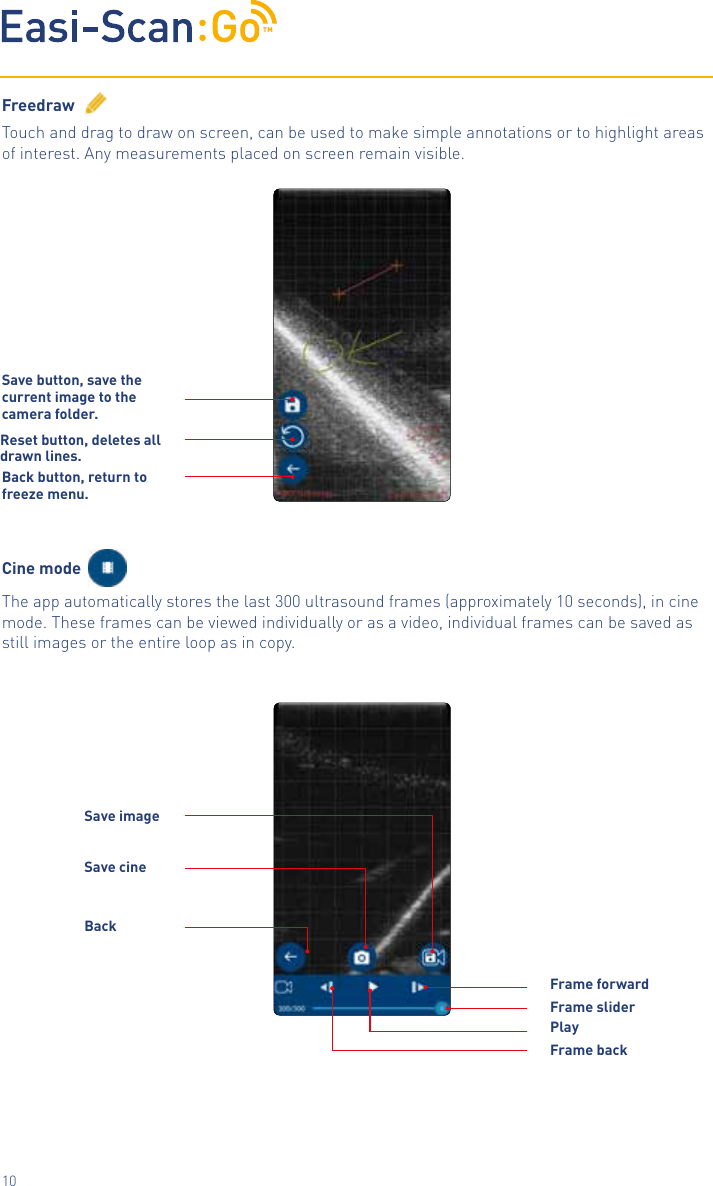 TM10FreedrawTouch and drag to draw on screen, can be used to make simple annotations or to highlight areas of interest. Any measurements placed on screen remain visible.Cine modeThe app automatically stores the last 300 ultrasound frames (approximately 10 seconds), in cine mode. These frames can be viewed individually or as a video, individual frames can be saved as still images or the entire loop as in copy.Reset button, deletes all drawn lines.Save button, save the current image to the camera folder.Back button, return to freeze menu.Frame backFrame forwardBackSave imageSave cinePlayFrame slider