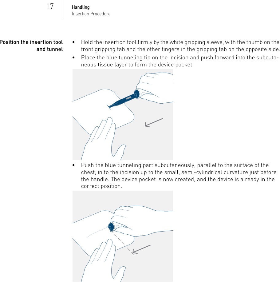 Page 17 of BIOTRONIK SE and KG BM2610 Implantable Cardiac Monitor User Manual P BL 0001136