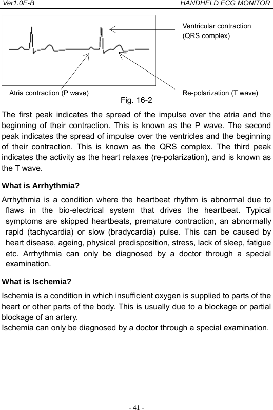 Ver1.0E-B                                          HANDHELD ECG MONITOR  - 41 - Fig. 16-2 The first peak indicates the spread of the impulse over the atria and the beginning of their contraction. This is known as the P wave. The second peak indicates the spread of impulse over the ventricles and the beginning of their contraction. This is known as the QRS complex. The third peak indicates the activity as the heart relaxes (re-polarization), and is known as the T wave. What is Arrhythmia? Arrhythmia is a condition where the heartbeat rhythm is abnormal due to flaws in the bio-electrical system that drives the heartbeat. Typical symptoms are skipped heartbeats, premature contraction, an abnormally rapid (tachycardia) or slow (bradycardia) pulse. This can be caused by heart disease, ageing, physical predisposition, stress, lack of sleep, fatigue etc. Arrhythmia can only be diagnosed by a doctor through a special examination. What is Ischemia? Ischemia is a condition in which insufficient oxygen is supplied to parts of the heart or other parts of the body. This is usually due to a blockage or partial blockage of an artery. Ischemia can only be diagnosed by a doctor through a special examination.     Ventricular contraction (QRS complex) Re-polarization (T wave)Atria contraction (P wave) 