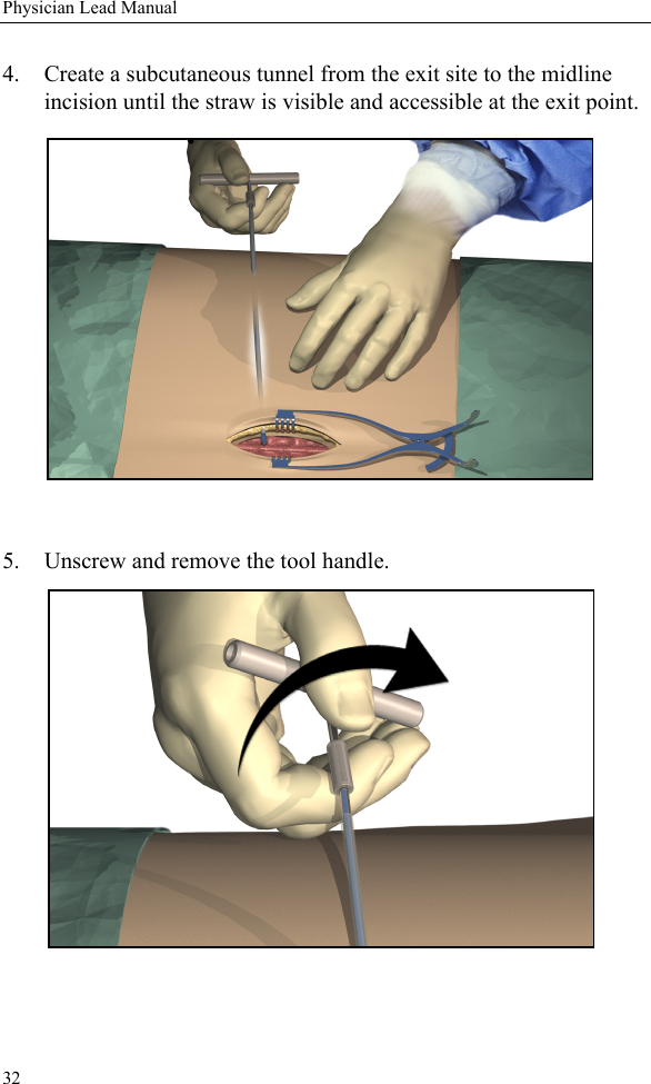 32Physician Lead Manual4. Create a subcutaneous tunnel from the exit site to the midline incision until the straw is visible and accessible at the exit point.5. Unscrew and remove the tool handle. 