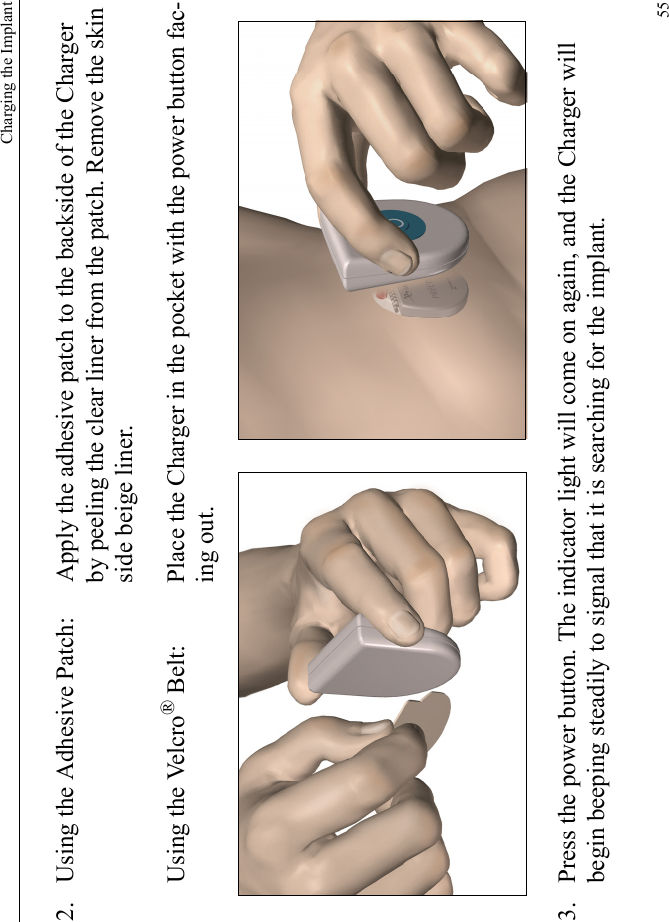 Charging the Implant552. Using the Adhesive Patch: Apply the adhesive patch to the backside of the Charger by peeling the clear liner from the patch. Remove the skin side beige liner.Using the Velcro® Belt: Place the Charger in the pocket with the power button fac-ing out. 3. Press the power button. The indicator light will come on again, and the Charger will begin beeping steadily to signal that it is searching for the implant.