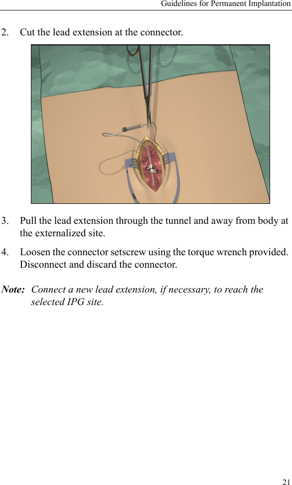 Guidelines for Permanent Implantation212. Cut the lead extension at the connector. 3. Pull the lead extension through the tunnel and away from body at the externalized site.4. Loosen the connector setscrew using the torque wrench provided. Disconnect and discard the connector.Note: Connect a new lead extension, if necessary, to reach the selected IPG site.