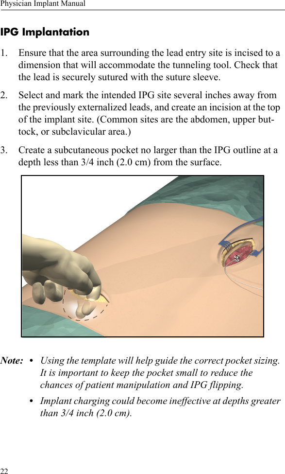 22Physician Implant ManualIPG Implantation1. Ensure that the area surrounding the lead entry site is incised to a dimension that will accommodate the tunneling tool. Check that the lead is securely sutured with the suture sleeve. 2. Select and mark the intended IPG site several inches away from the previously externalized leads, and create an incision at the top of the implant site. (Common sites are the abdomen, upper but-tock, or subclavicular area.)3. Create a subcutaneous pocket no larger than the IPG outline at a depth less than 3/4 inch (2.0 cm) from the surface. Note: • Using the template will help guide the correct pocket sizing. It is important to keep the pocket small to reduce the chances of patient manipulation and IPG flipping.•Implant charging could become ineffective at depths greater than 3/4 inch (2.0 cm).