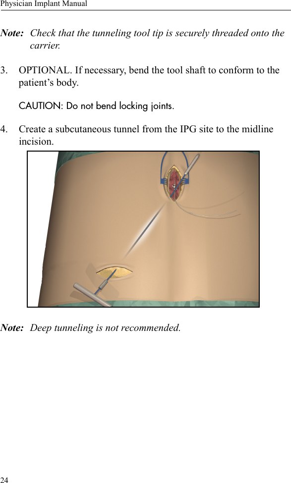 24Physician Implant ManualNote: Check that the tunneling tool tip is securely threaded onto the carrier.3. OPTIONAL. If necessary, bend the tool shaft to conform to the patient’s body. CAUTION: Do not bend locking joints.4. Create a subcutaneous tunnel from the IPG site to the midline incision.Note: Deep tunneling is not recommended.