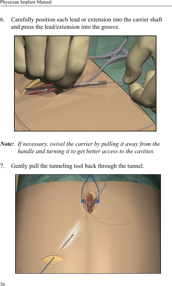26Physician Implant Manual6. Carefully position each lead or extension into the carrier shaft and press the lead/extension into the groove.Note: If necessary, swivel the carrier by pulling it away from the handle and turning it to get better access to the cavities. 7. Gently pull the tunneling tool back through the tunnel.