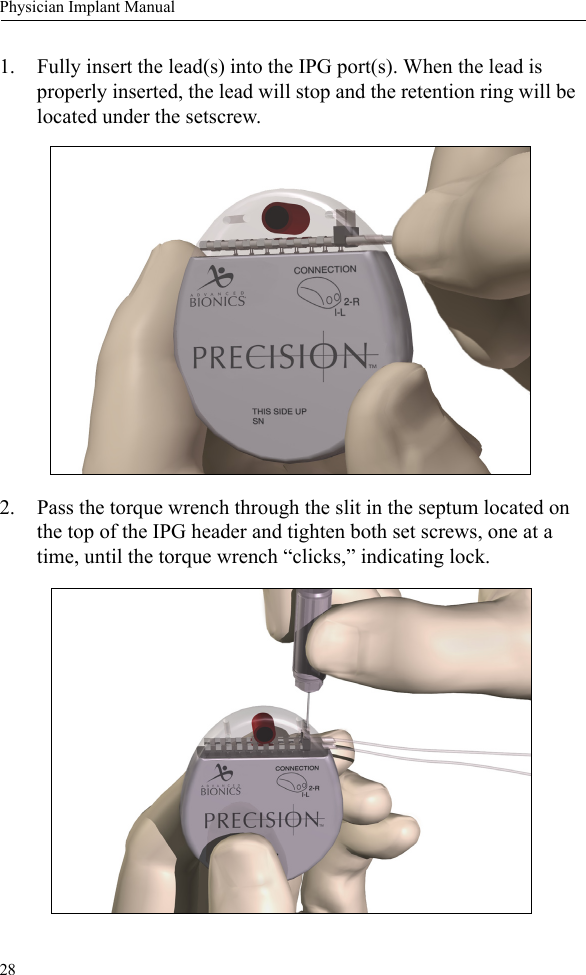 28Physician Implant Manual1. Fully insert the lead(s) into the IPG port(s). When the lead is properly inserted, the lead will stop and the retention ring will be located under the setscrew. 2. Pass the torque wrench through the slit in the septum located on the top of the IPG header and tighten both set screws, one at a time, until the torque wrench “clicks,” indicating lock. 