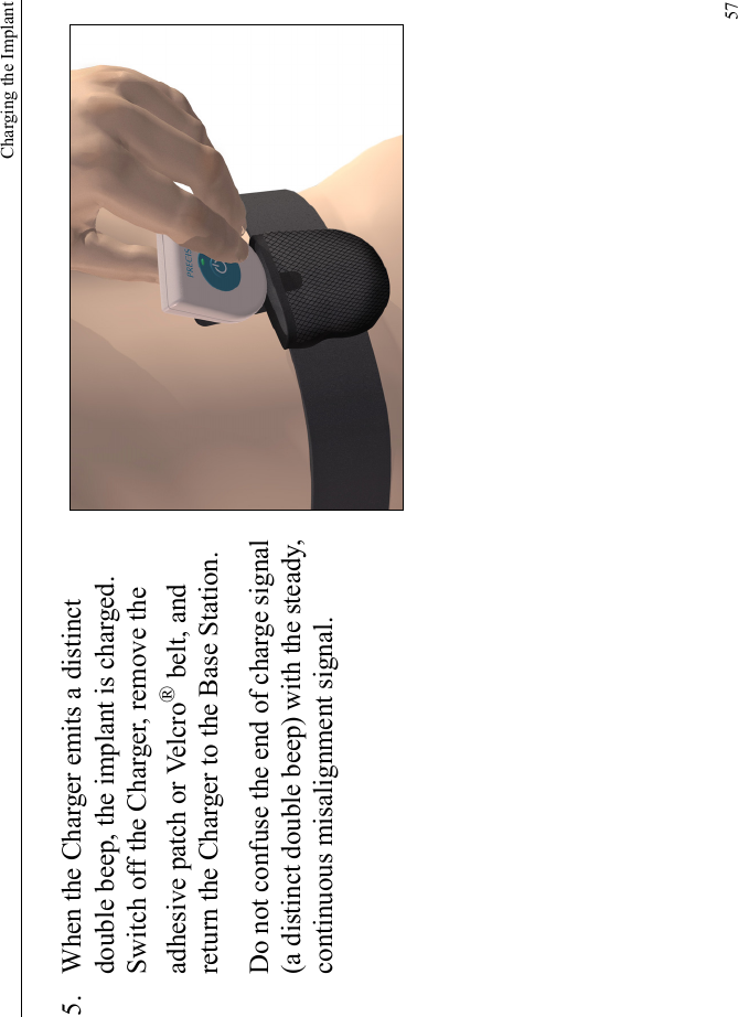 Charging the Implant575. When the Charger emits a distinct double beep, the implant is charged. Switch off the Charger, remove the adhesive patch or Velcro® belt, and return the Charger to the Base Station.Do not confuse the end of charge signal (a distinct double beep) with the steady, continuous misalignment signal.