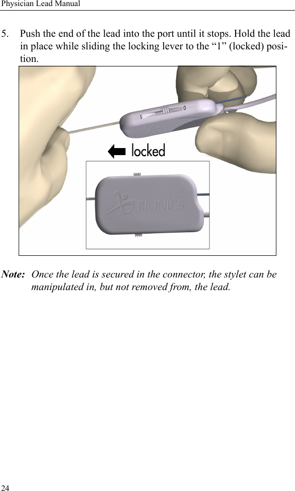 24Physician Lead Manual5. Push the end of the lead into the port until it stops. Hold the lead in place while sliding the locking lever to the “1” (locked) posi-tion. Note: Once the lead is secured in the connector, the stylet can be manipulated in, but not removed from, the lead.