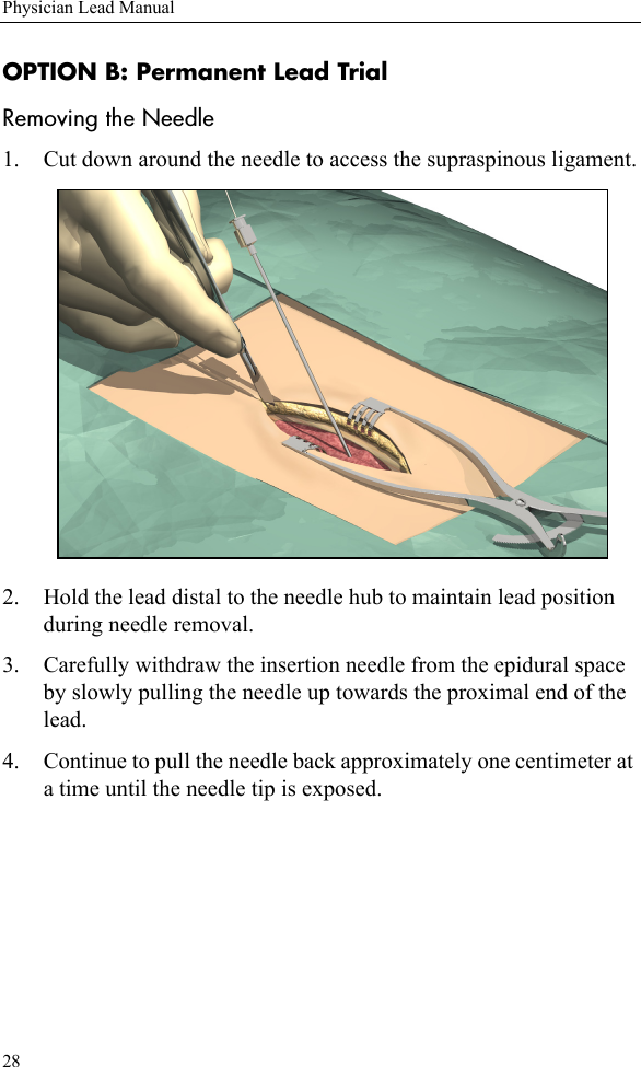 28Physician Lead ManualOPTION B: Permanent Lead TrialRemoving the Needle1. Cut down around the needle to access the supraspinous ligament.2. Hold the lead distal to the needle hub to maintain lead position during needle removal.3. Carefully withdraw the insertion needle from the epidural space by slowly pulling the needle up towards the proximal end of the lead.4. Continue to pull the needle back approximately one centimeter at a time until the needle tip is exposed.