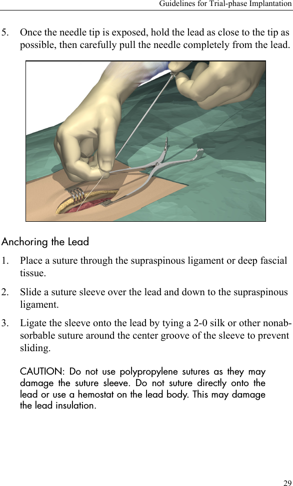 Guidelines for Trial-phase Implantation295. Once the needle tip is exposed, hold the lead as close to the tip as possible, then carefully pull the needle completely from the lead.Anchoring the Lead1. Place a suture through the supraspinous ligament or deep fascial tissue.2. Slide a suture sleeve over the lead and down to the supraspinous ligament.3. Ligate the sleeve onto the lead by tying a 2-0 silk or other nonab-sorbable suture around the center groove of the sleeve to prevent sliding. CAUTION: Do not use polypropylene sutures as they maydamage the suture sleeve. Do not suture directly onto thelead or use a hemostat on the lead body. This may damagethe lead insulation.