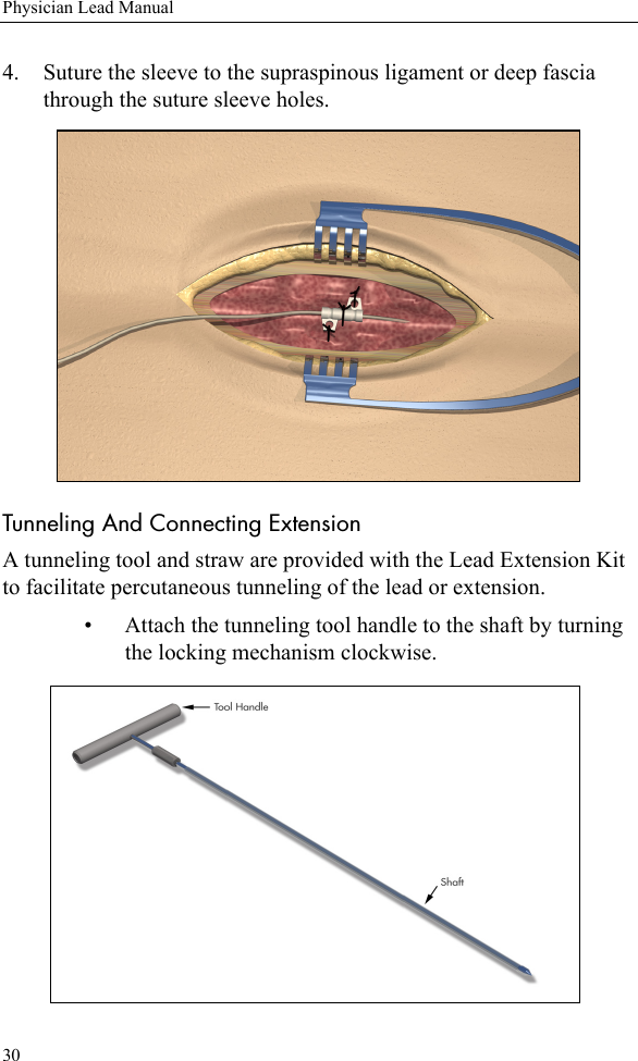 30Physician Lead Manual4. Suture the sleeve to the supraspinous ligament or deep fascia through the suture sleeve holes.Tunneling And Connecting ExtensionA tunneling tool and straw are provided with the Lead Extension Kit to facilitate percutaneous tunneling of the lead or extension. • Attach the tunneling tool handle to the shaft by turning the locking mechanism clockwise.