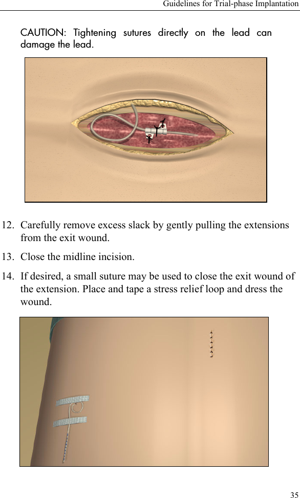 Guidelines for Trial-phase Implantation35CAUTION: Tightening sutures directly on the lead candamage the lead. 12. Carefully remove excess slack by gently pulling the extensions from the exit wound.13. Close the midline incision. 14. If desired, a small suture may be used to close the exit wound of the extension. Place and tape a stress relief loop and dress the wound.