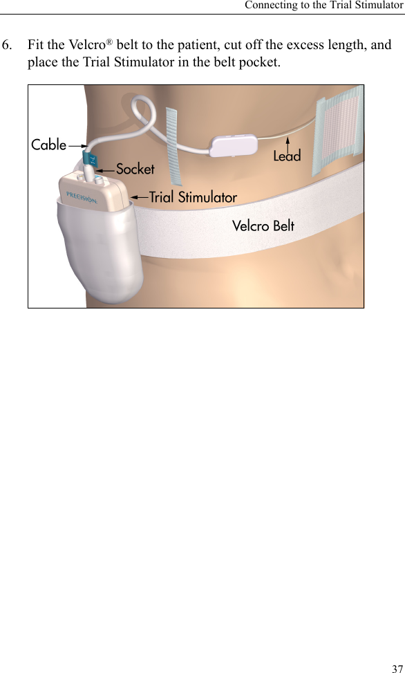 Connecting to the Trial Stimulator376. Fit the Velcro® belt to the patient, cut off the excess length, and place the Trial Stimulator in the belt pocket.