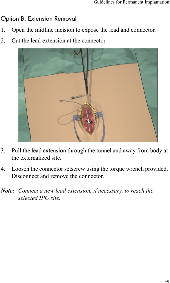 Guidelines for Permanent Implantation39Option B. Extension Removal1. Open the midline incision to expose the lead and connector.2. Cut the lead extension at the connector. 3. Pull the lead extension through the tunnel and away from body at the externalized site.4. Loosen the connector setscrew using the torque wrench provided. Disconnect and remove the connector.Note: Connect a new lead extension, if necessary, to reach the selected IPG site.