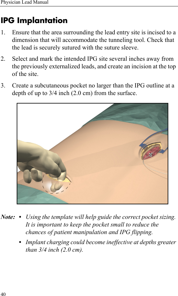 40Physician Lead ManualIPG Implantation1. Ensure that the area surrounding the lead entry site is incised to a dimension that will accommodate the tunneling tool. Check that the lead is securely sutured with the suture sleeve. 2. Select and mark the intended IPG site several inches away from the previously externalized leads, and create an incision at the top of the site.3. Create a subcutaneous pocket no larger than the IPG outline at a depth of up to 3/4 inch (2.0 cm) from the surface. Note: • Using the template will help guide the correct pocket sizing. It is important to keep the pocket small to reduce the chances of patient manipulation and IPG flipping.•Implant charging could become ineffective at depths greater than 3/4 inch (2.0 cm). 