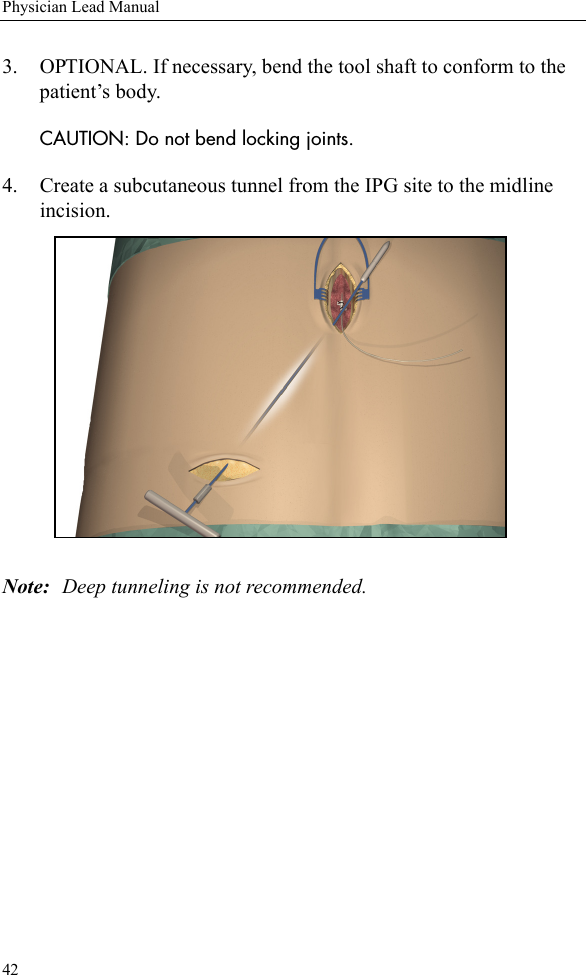 42Physician Lead Manual3. OPTIONAL. If necessary, bend the tool shaft to conform to the patient’s body. CAUTION: Do not bend locking joints. 4. Create a subcutaneous tunnel from the IPG site to the midline incision.Note: Deep tunneling is not recommended.