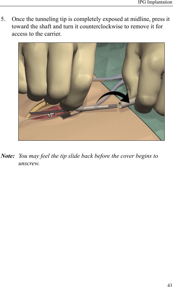 IPG Implantation435. Once the tunneling tip is completely exposed at midline, press it toward the shaft and turn it counterclockwise to remove it for access to the carrier. Note: You may feel the tip slide back before the cover begins to unscrew. 