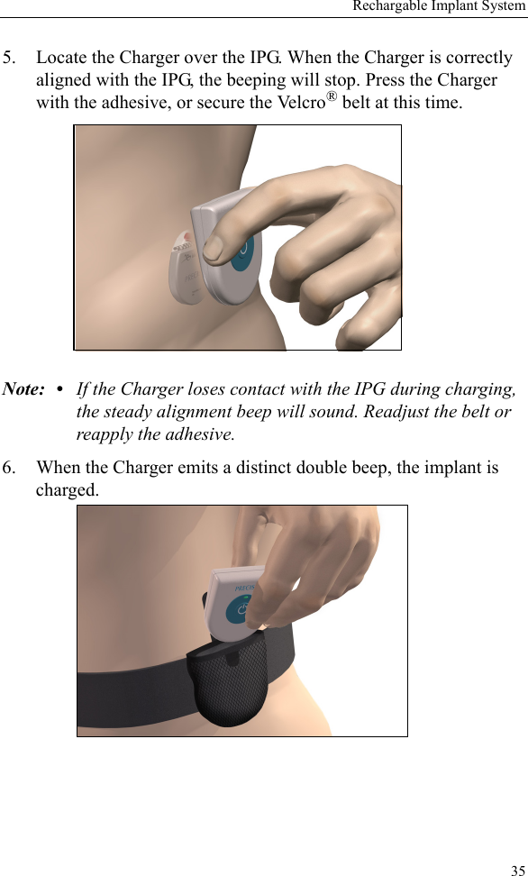 Rechargable Implant System355. Locate the Charger over the IPG. When the Charger is correctly aligned with the IPG, the beeping will stop. Press the Charger with the adhesive, or secure the Velcro® belt at this time.Note: • If the Charger loses contact with the IPG during charging, the steady alignment beep will sound. Readjust the belt or reapply the adhesive.6. When the Charger emits a distinct double beep, the implant is charged.