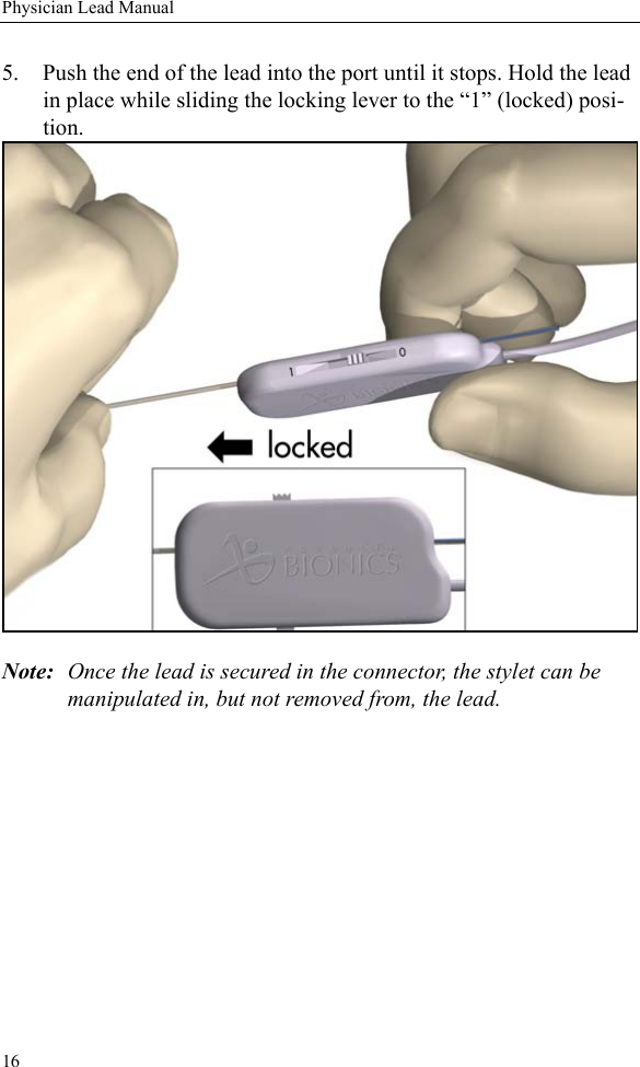 16Physician Lead Manual5. Push the end of the lead into the port until it stops. Hold the lead in place while sliding the locking lever to the “1” (locked) posi-tion. Note: Once the lead is secured in the connector, the stylet can be manipulated in, but not removed from, the lead.