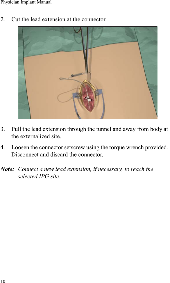 10Physician Implant Manual2. Cut the lead extension at the connector. 3. Pull the lead extension through the tunnel and away from body at the externalized site.4. Loosen the connector setscrew using the torque wrench provided. Disconnect and discard the connector.Note: Connect a new lead extension, if necessary, to reach the selected IPG site.
