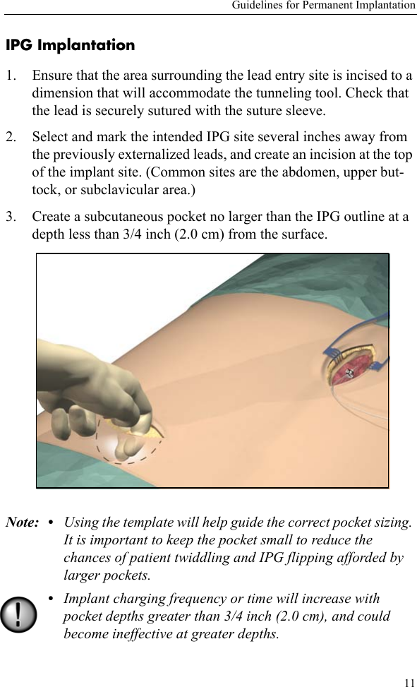 Guidelines for Permanent Implantation11IPG Implantation1. Ensure that the area surrounding the lead entry site is incised to a dimension that will accommodate the tunneling tool. Check that the lead is securely sutured with the suture sleeve. 2. Select and mark the intended IPG site several inches away from the previously externalized leads, and create an incision at the top of the implant site. (Common sites are the abdomen, upper but-tock, or subclavicular area.)3. Create a subcutaneous pocket no larger than the IPG outline at a depth less than 3/4 inch (2.0 cm) from the surface. Note: • Using the template will help guide the correct pocket sizing. It is important to keep the pocket small to reduce the chances of patient twiddling and IPG flipping afforded by larger pockets.•Implant charging frequency or time will increase with pocket depths greater than 3/4 inch (2.0 cm), and could become ineffective at greater depths.