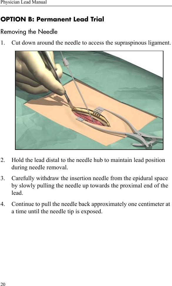 20Physician Lead ManualOPTION B: Permanent Lead TrialRemoving the Needle1. Cut down around the needle to access the supraspinous ligament.2. Hold the lead distal to the needle hub to maintain lead position during needle removal.3. Carefully withdraw the insertion needle from the epidural space by slowly pulling the needle up towards the proximal end of the lead.4. Continue to pull the needle back approximately one centimeter at a time until the needle tip is exposed.