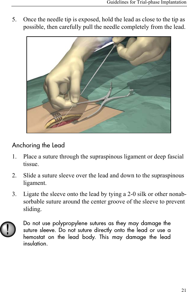 Guidelines for Trial-phase Implantation215. Once the needle tip is exposed, hold the lead as close to the tip as possible, then carefully pull the needle completely from the lead.Anchoring the Lead1. Place a suture through the supraspinous ligament or deep fascial tissue.2. Slide a suture sleeve over the lead and down to the supraspinous ligament.3. Ligate the sleeve onto the lead by tying a 2-0 silk or other nonab-sorbable suture around the center groove of the sleeve to prevent sliding. Do not use polypropylene sutures as they may damage thesuture sleeve. Do not suture directly onto the lead or use ahemostat on the lead body. This may damage the leadinsulation.
