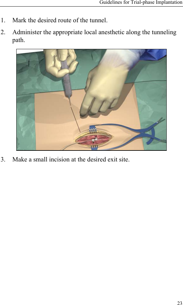Guidelines for Trial-phase Implantation231. Mark the desired route of the tunnel.2. Administer the appropriate local anesthetic along the tunneling path.3. Make a small incision at the desired exit site.