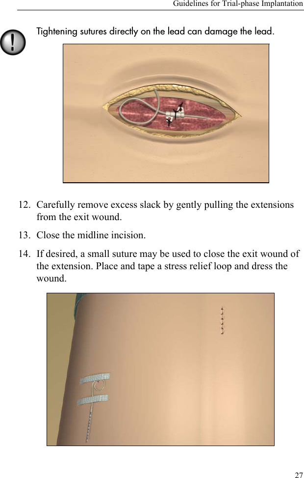 Guidelines for Trial-phase Implantation27Tightening sutures directly on the lead can damage the lead. 12. Carefully remove excess slack by gently pulling the extensions from the exit wound.13. Close the midline incision. 14. If desired, a small suture may be used to close the exit wound of the extension. Place and tape a stress relief loop and dress the wound.