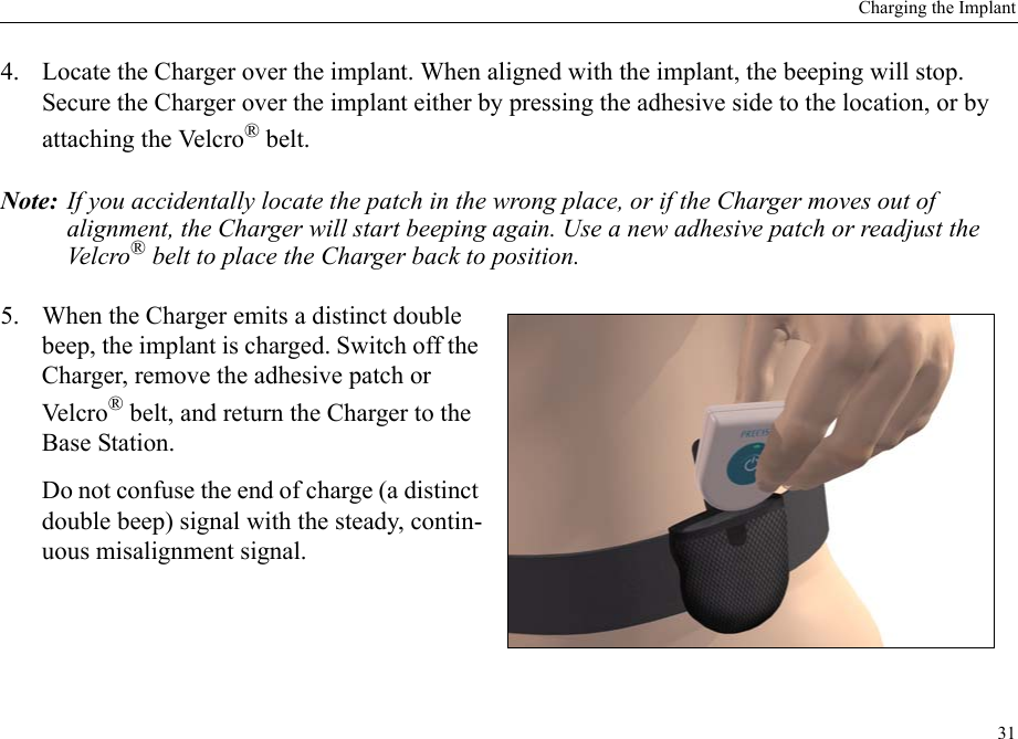 Charging the Implant314. Locate the Charger over the implant. When aligned with the implant, the beeping will stop. Secure the Charger over the implant either by pressing the adhesive side to the location, or by attaching the Velcro® belt.Note: If you accidentally locate the patch in the wrong place, or if the Charger moves out of alignment, the Charger will start beeping again. Use a new adhesive patch or readjust the Ve l c ro ® belt to place the Charger back to position.5. When the Charger emits a distinct double beep, the implant is charged. Switch off the Charger, remove the adhesive patch or Velcro ® belt, and return the Charger to the Base Station.Do not confuse the end of charge (a distinct double beep) signal with the steady, contin-uous misalignment signal.