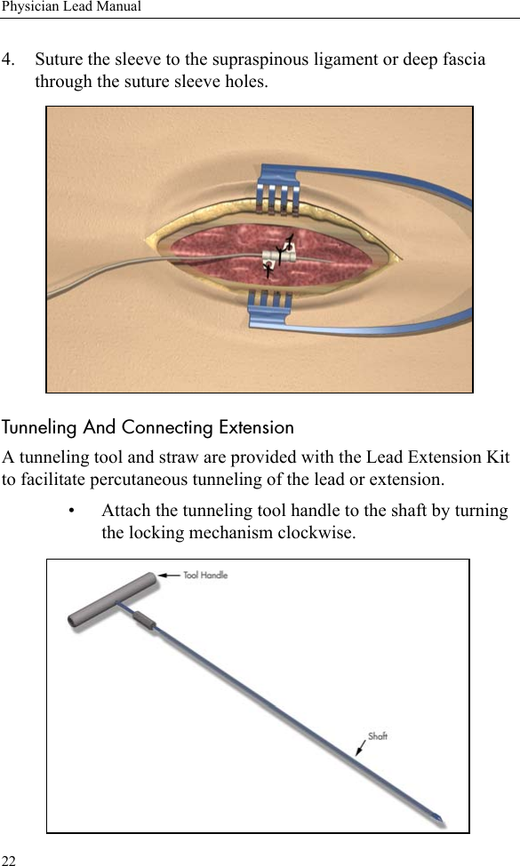 22Physician Lead Manual4. Suture the sleeve to the supraspinous ligament or deep fascia through the suture sleeve holes.Tunneling And Connecting ExtensionA tunneling tool and straw are provided with the Lead Extension Kit to facilitate percutaneous tunneling of the lead or extension. • Attach the tunneling tool handle to the shaft by turning the locking mechanism clockwise.