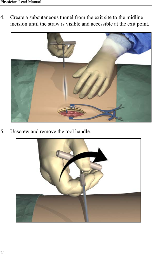24Physician Lead Manual4. Create a subcutaneous tunnel from the exit site to the midline incision until the straw is visible and accessible at the exit point.5. Unscrew and remove the tool handle. 