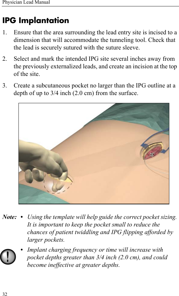 32Physician Lead ManualIPG Implantation1. Ensure that the area surrounding the lead entry site is incised to a dimension that will accommodate the tunneling tool. Check that the lead is securely sutured with the suture sleeve. 2. Select and mark the intended IPG site several inches away from the previously externalized leads, and create an incision at the top of the site.3. Create a subcutaneous pocket no larger than the IPG outline at a depth of up to 3/4 inch (2.0 cm) from the surface. Note: • Using the template will help guide the correct pocket sizing. It is important to keep the pocket small to reduce the chances of patient twiddling and IPG flipping afforded by larger pockets.•Implant charging frequency or time will increase with pocket depths greater than 3/4 inch (2.0 cm), and could become ineffective at greater depths.