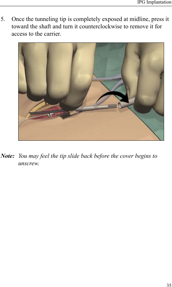 IPG Implantation355. Once the tunneling tip is completely exposed at midline, press it toward the shaft and turn it counterclockwise to remove it for access to the carrier. Note: You may feel the tip slide back before the cover begins to unscrew. 