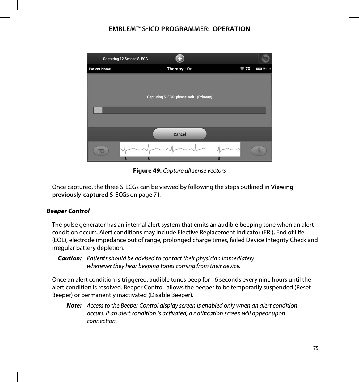75EMBLEM™ SICD PROGRAMMER:  OPERATIONFigure 49: Capture all sense vectorsOnce captured, the three S-ECGs can be viewed by following the steps outlined in Viewing previously-captured S-ECGs on page 71.Beeper ControlThe pulse generator has an internal alert system that emits an audible beeping tone when an alert condition occurs. Alert conditions may include Elective Replacement Indicator (ERI), End of Life (EOL), electrode impedance out of range, prolonged charge times, failed Device Integrity Check and irregular battery depletion. Caution:  Patients should be advised to contact their physician immediately whenever they hear beeping tones coming from their device.Once an alert condition is triggered, audible tones beep for 16 seconds every nine hours until the alert condition is resolved. Beeper Control  allows the beeper to be temporarily suspended (Reset Beeper) or permanently inactivated (Disable Beeper).Note:  Access to the Beeper Control display screen is enabled only when an alert condition occurs. If an alert condition is activated, a notication screen will appear upon connection.