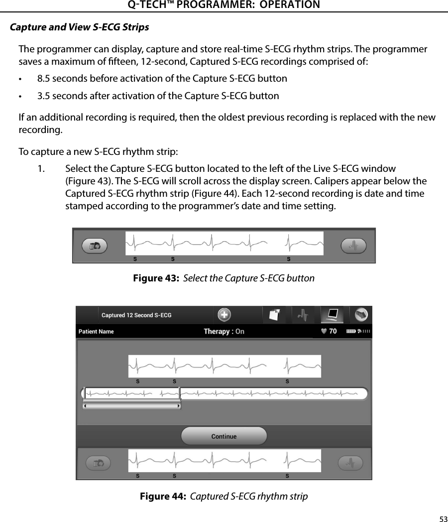 53QTECH™ PROGRAMMER:  OPERATIONCapture and View S-ECG StripsThe programmer can display, capture and store real-time S-ECG rhythm strips. The programmer saves a maximum of fteen, 12-second, Captured S-ECG recordings comprised of:•  8.5 seconds before activation of the Capture S-ECG button•  3.5 seconds after activation of the Capture S-ECG buttonIf an additional recording is required, then the oldest previous recording is replaced with the new recording.To capture a new S-ECG rhythm strip:1.  Select the Capture S-ECG button located to the left of the Live S-ECG window (Figure 43). The S-ECG will scroll across the display screen. Calipers appear below the Captured S-ECG rhythm strip (Figure 44). Each 12-second recording is date and time stamped according to the programmer’s date and time setting.Figure 43:  Select the Capture S-ECG buttonFigure 44:  Captured S-ECG rhythm strip