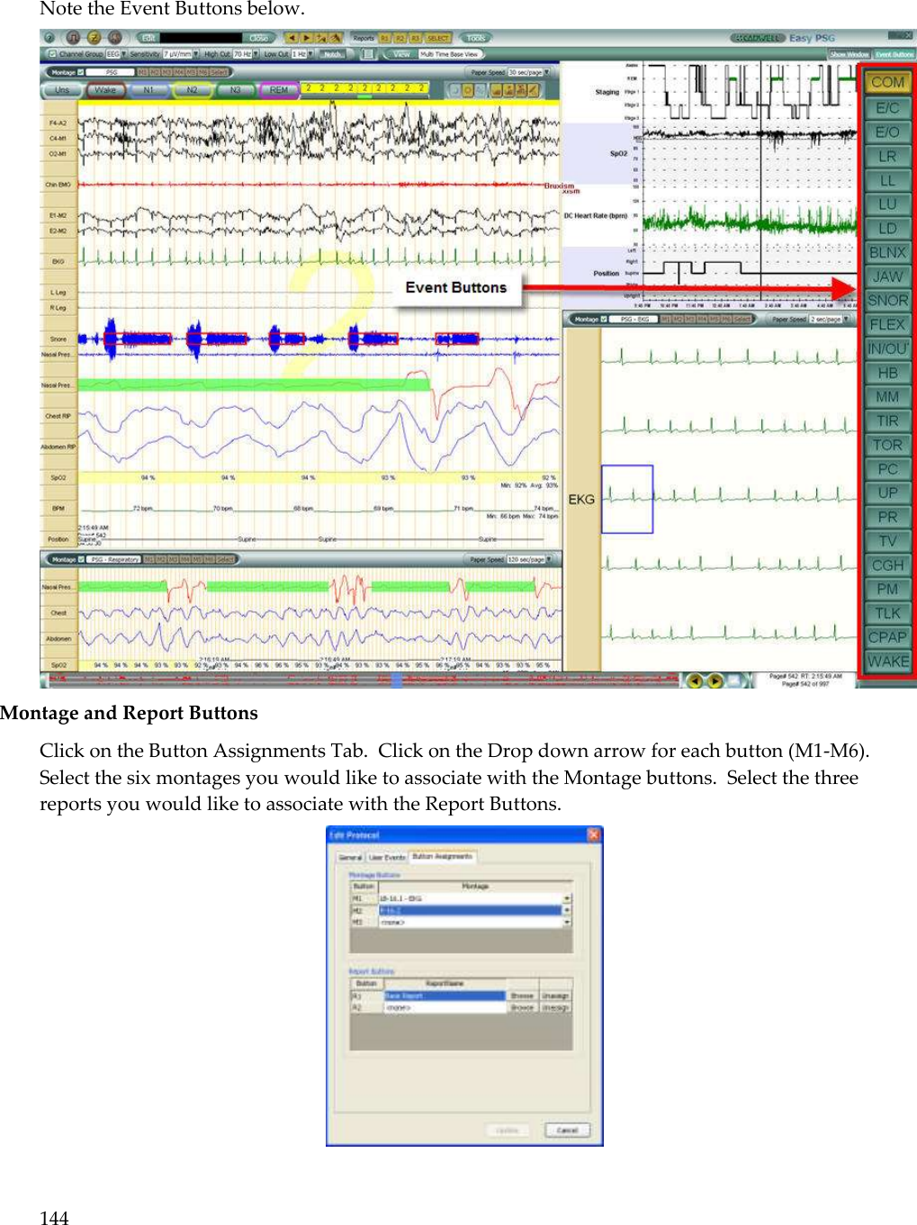 144  Note the Event Buttons below.  Montage and Report Buttons Click on the Button Assignments Tab.  Click on the Drop down arrow for each button (M1-M6).  Select the six montages you would like to associate with the Montage buttons.  Select the three reports you would like to associate with the Report Buttons.   
