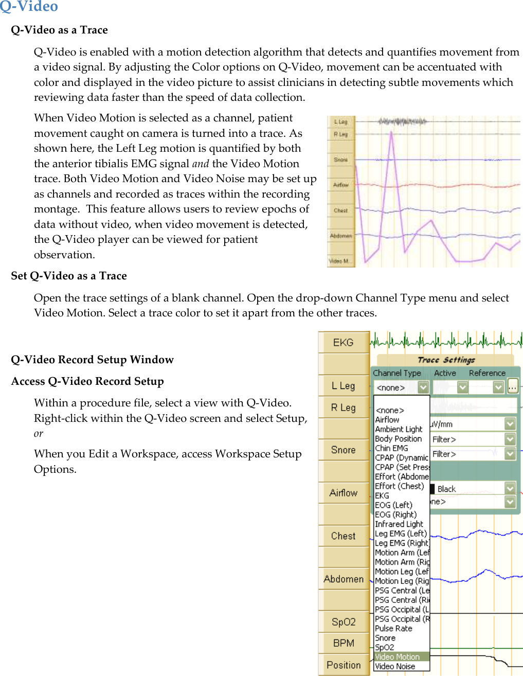  Q-Video Q-Video as a Trace Q-Video is enabled with a motion detection algorithm that detects and quantifies movement from a video signal. By adjusting the Color options on Q-Video, movement can be accentuated with color and displayed in the video picture to assist clinicians in detecting subtle movements which reviewing data faster than the speed of data collection.  When Video Motion is selected as a channel, patient movement caught on camera is turned into a trace. As shown here, the Left Leg motion is quantified by both the anterior tibialis EMG signal and the Video Motion trace. Both Video Motion and Video Noise may be set up as channels and recorded as traces within the recording montage.  This feature allows users to review epochs of data without video, when video movement is detected, the Q-Video player can be viewed for patient observation. Set Q-Video as a Trace Open the trace settings of a blank channel. Open the drop-down Channel Type menu and select Video Motion. Select a trace color to set it apart from the other traces.   Q-Video Record Setup Window Access Q-Video Record Setup Within a procedure file, select a view with Q-Video. Right-click within the Q-Video screen and select Setup, or When you Edit a Workspace, access Workspace Setup Options. 