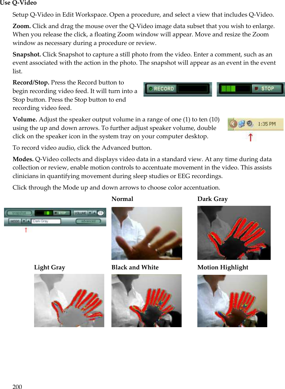 200  Use Q-Video Setup Q-Video in Edit Workspace. Open a procedure, and select a view that includes Q-Video.  Zoom. Click and drag the mouse over the Q-Video image data subset that you wish to enlarge. When you release the click, a floating Zoom window will appear. Move and resize the Zoom window as necessary during a procedure or review. Snapshot. Click Snapshot to capture a still photo from the video. Enter a comment, such as an event associated with the action in the photo. The snapshot will appear as an event in the event list.  Record/Stop. Press the Record button to begin recording video feed. It will turn into a Stop button. Press the Stop button to end recording video feed.   Volume. Adjust the speaker output volume in a range of one (1) to ten (10) using the up and down arrows. To further adjust speaker volume, double click on the speaker icon in the system tray on your computer desktop. To record video audio, click the Advanced button. Modes. Q-Video collects and displays video data in a standard view. At any time during data collection or review, enable motion controls to accentuate movement in the video. This assists clinicians in quantifying movement during sleep studies or EEG recordings.  Click through the Mode up and down arrows to choose color accentuation. Normal       Dark Gray              Light Gray      Black and White     Motion Highlight      