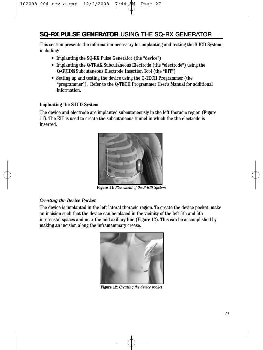 27SQ-RX PULSE GENERATORSQ-RX PULSE GENERATOR USING THE SQ-RX GENERATORThis section presents the information necessary for implanting and testing the S-ICD System,including:•  Implanting the SQ-RX Pulse Generator (the “device”)•  Implanting the Q-TRAK Subcutaneous Electrode (the “electrode”) using theQ-GUIDE Subcutaneous Electrode Insertion Tool (the “EIT”)•  Setting up and testing the device using the Q-TECH Programmer (the“programmer”).  Refer to the Q-TECH Programmer User’s Manual for additionalinformation.Implanting the S-ICD SystemThe device and electrode are implanted subcutaneously in the left thoracic region (Figure11). The EIT is used to create the subcutaneous tunnel in which the the electrode isinserted. Creating the Device PocketThe device is implanted in the left lateral thoracic region. To create the device pocket, makean incision such that the device can be placed in the vicinity of the left 5th and 6thintercostal spaces and near the mid-axillary line (Figure 12). This can be accomplished bymaking an incision along the inframammary crease.Figure 12: Creating the device pocketFigure 11: Placement of the S-ICD System102098 004 rev a.qxp  12/2/2008  7:44 AM  Page 27