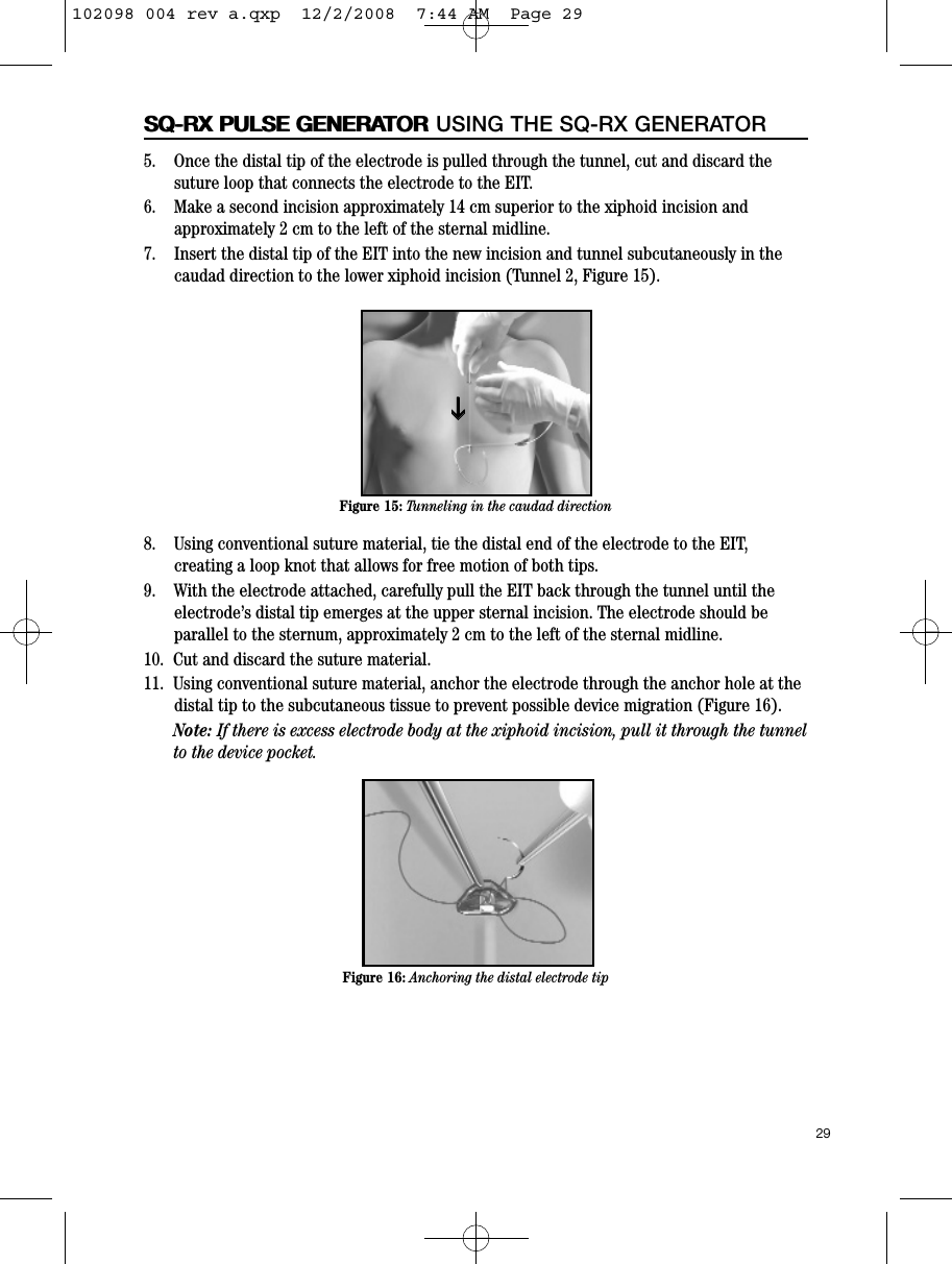 29SQ-RX PULSE GENERATORSQ-RX PULSE GENERATOR USING THE SQ-RX GENERATOR5.    Once the distal tip of the electrode is pulled through the tunnel, cut and discard thesuture loop that connects the electrode to the EIT.6.    Make a second incision approximately 14 cm superior to the xiphoid incision andapproximately 2 cm to the left of the sternal midline.7.    Insert the distal tip of the EIT into the new incision and tunnel subcutaneously in thecaudad direction to the lower xiphoid incision (Tunnel 2, Figure 15). 8.    Using conventional suture material, tie the distal end of the electrode to the EIT,creating a loop knot that allows for free motion of both tips.9.    With the electrode attached, carefully pull the EIT back through the tunnel until theelectrode’s distal tip emerges at the upper sternal incision. The electrode should beparallel to the sternum, approximately 2 cm to the left of the sternal midline.10.  Cut and discard the suture material.  11.  Using conventional suture material, anchor the electrode through the anchor hole at thedistal tip to the subcutaneous tissue to prevent possible device migration (Figure 16). Note: If there is excess electrode body at the xiphoid incision, pull it through the tunnelto the device pocket.Figure 15: Tunneling in the caudad directionFigure 16: Anchoring the distal electrode tipII102098 004 rev a.qxp  12/2/2008  7:44 AM  Page 29