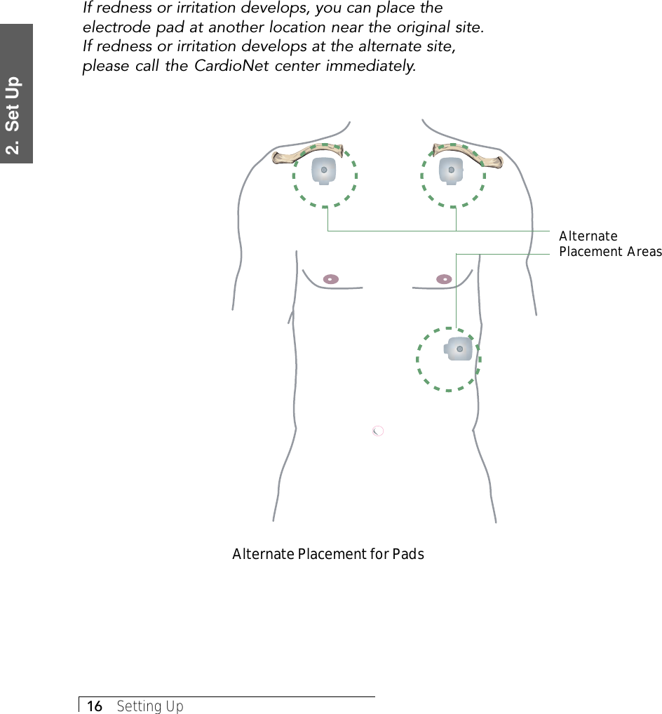 2.  Set Up16     Setting UpIf redness or irritation develops, you can place theelectrode pad at another location near the original site.If redness or irritation develops at the alternate site,please call the CardioNet center immediately.Alternate Placement for PadsAlternatePlacement Areas