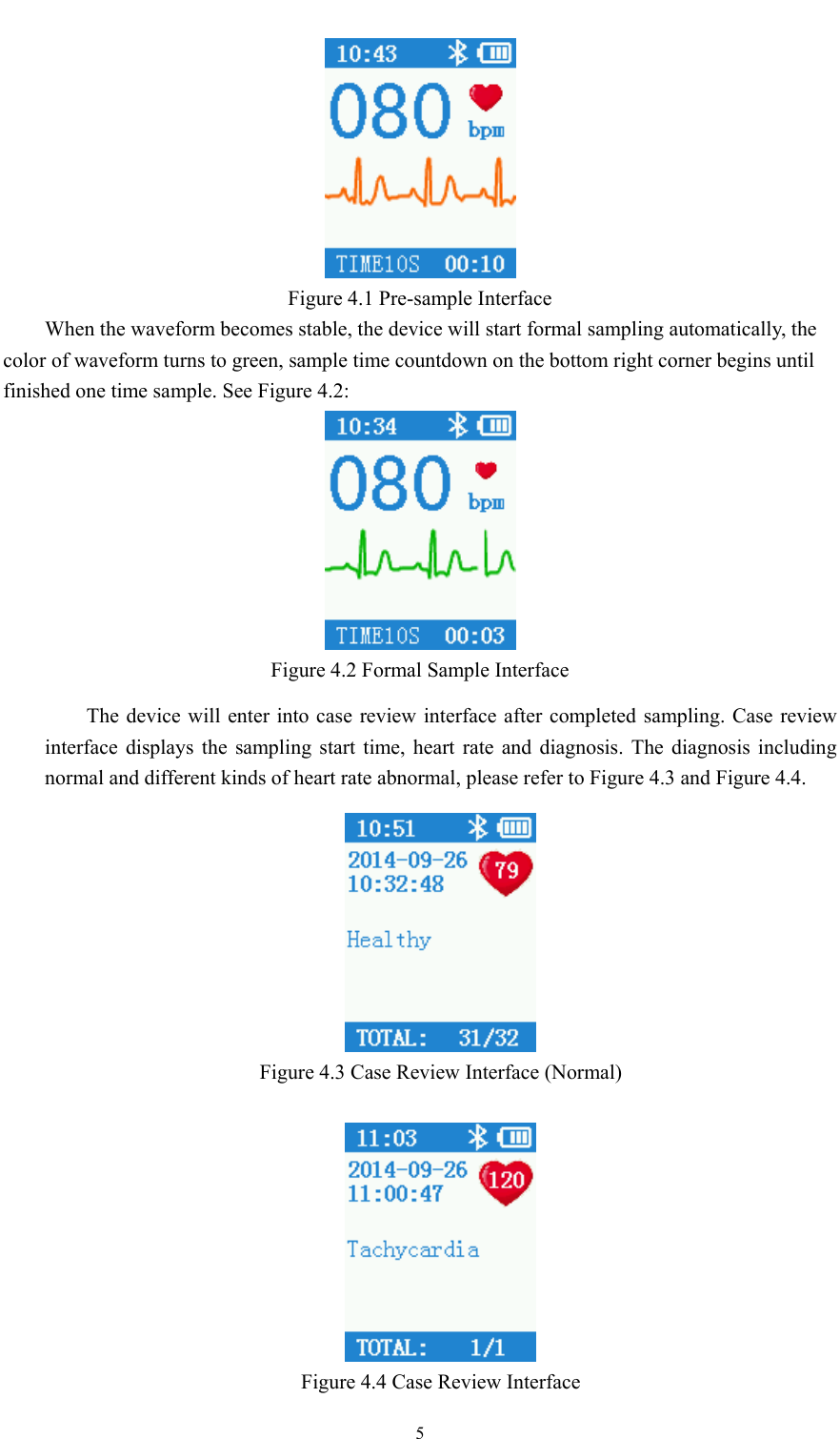  5   Figure 4.1 Pre-sample Interface When the waveform becomes stable, the device will start formal sampling automatically, the color of waveform turns to green, sample time countdown on the bottom right corner begins until finished one time sample. See Figure 4.2:  Figure 4.2 Formal Sample Interface The device will enter into case review interface after completed sampling. Case review interface displays the sampling start time, heart rate and diagnosis. The diagnosis including normal and different kinds of heart rate abnormal, please refer to Figure 4.3 and Figure 4.4.  Figure 4.3 Case Review Interface (Normal)   Figure 4.4 Case Review Interface 