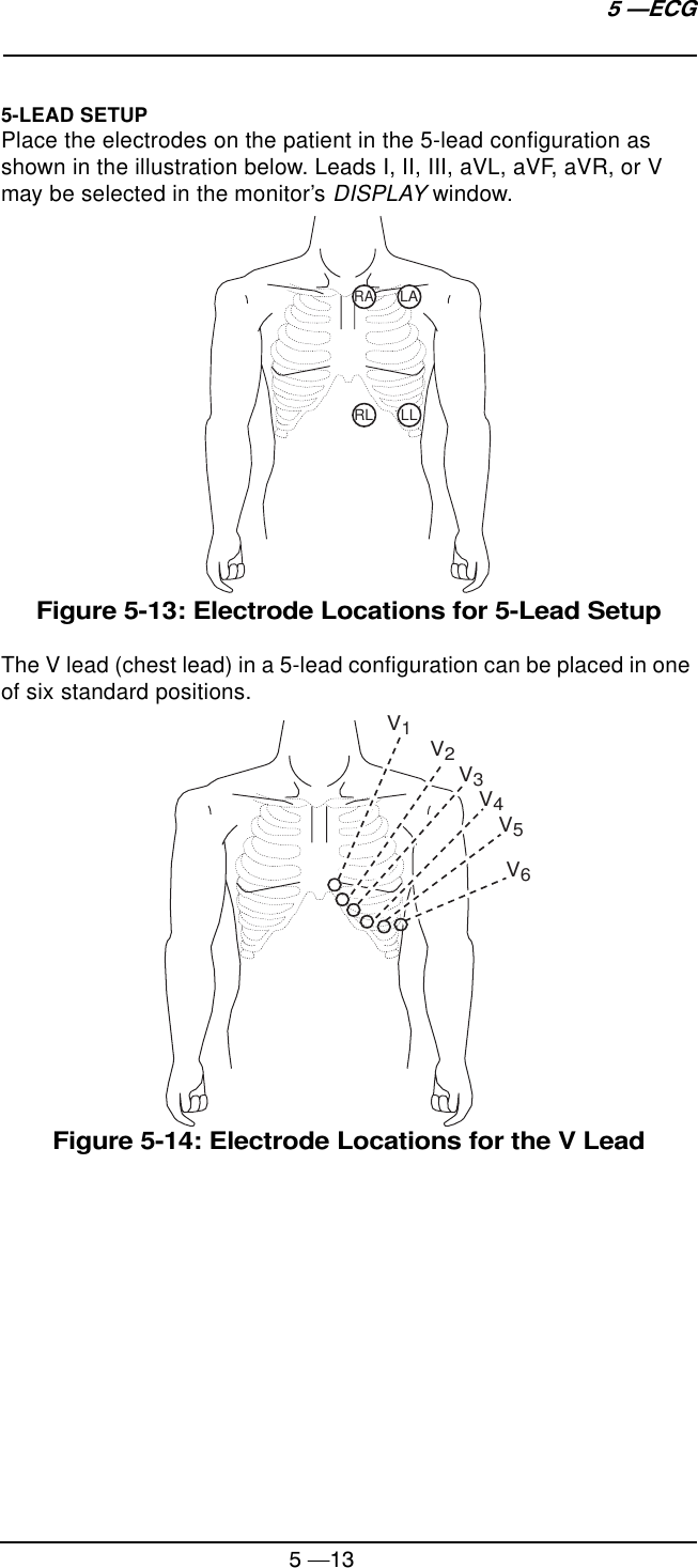 5 —135 —ECG5-LEAD SETUPPlace the electrodes on the patient in the 5-lead configuration as shown in the illustration below. Leads I, II, III, aVL, aVF, aVR, or V may be selected in the monitor’s DISPLAY window.Figure 5-13: Electrode Locations for 5-Lead SetupThe V lead (chest lead) in a 5-lead configuration can be placed in one of six standard positions.Figure 5-14: Electrode Locations for the V LeadRARL LLLAV1V2V3V4V5V6