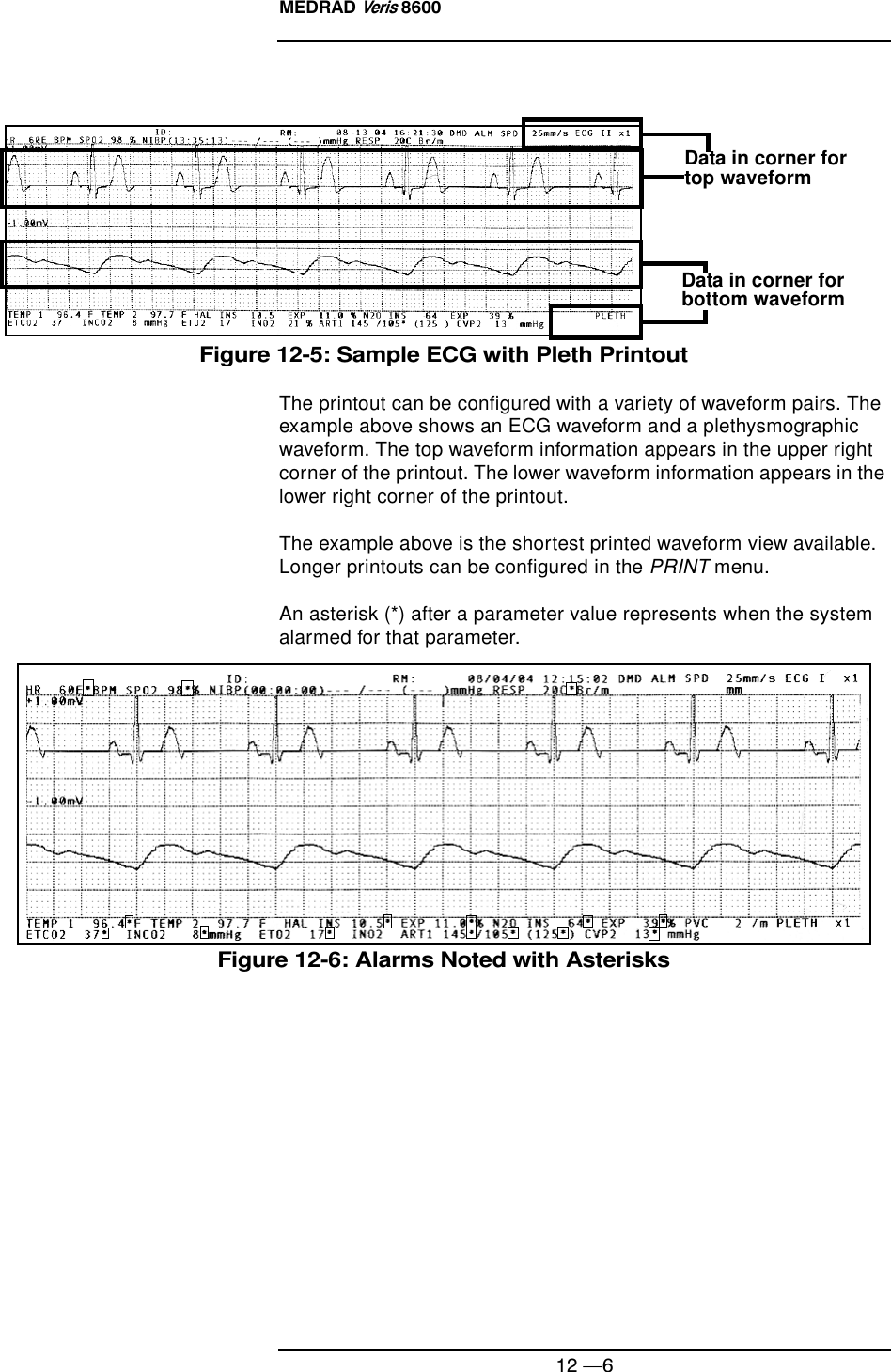 MEDRAD Veris 860012 —6Figure 12-5: Sample ECG with Pleth PrintoutThe printout can be configured with a variety of waveform pairs. The example above shows an ECG waveform and a plethysmographic waveform. The top waveform information appears in the upper right corner of the printout. The lower waveform information appears in the lower right corner of the printout.The example above is the shortest printed waveform view available. Longer printouts can be configured in the PRINT menu.An asterisk (*) after a parameter value represents when the system alarmed for that parameter.Figure 12-6: Alarms Noted with AsterisksData in corner for top waveformData in corner for bottom waveform