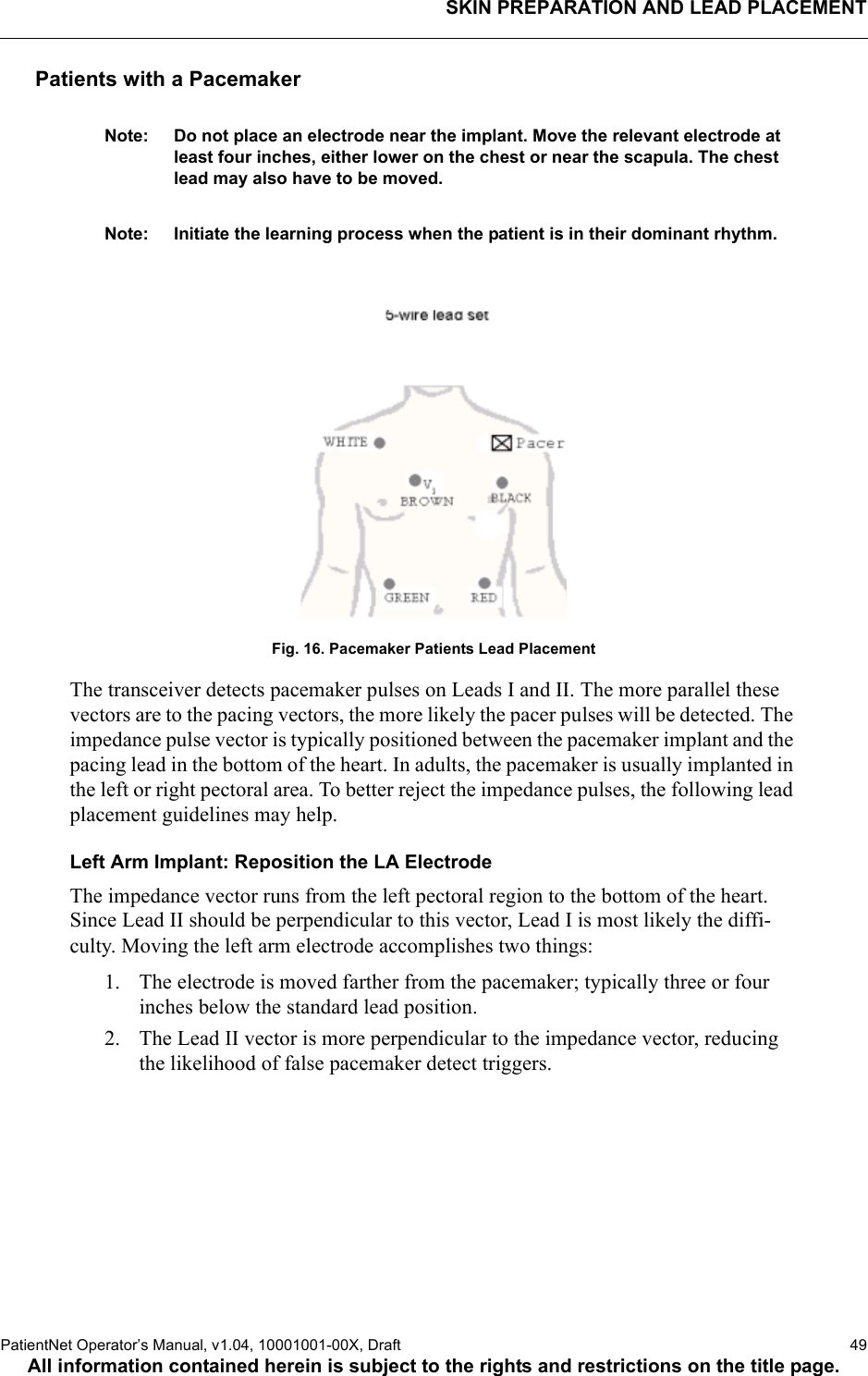 SKIN PREPARATION AND LEAD PLACEMENTPatientNet Operator’s Manual, v1.04, 10001001-00X, Draft   49All information contained herein is subject to the rights and restrictions on the title page.Patients with a PacemakerNote: Do not place an electrode near the implant. Move the relevant electrode at least four inches, either lower on the chest or near the scapula. The chest lead may also have to be moved.Note: Initiate the learning process when the patient is in their dominant rhythm.Fig. 16. Pacemaker Patients Lead PlacementThe transceiver detects pacemaker pulses on Leads I and II. The more parallel these vectors are to the pacing vectors, the more likely the pacer pulses will be detected. The impedance pulse vector is typically positioned between the pacemaker implant and the pacing lead in the bottom of the heart. In adults, the pacemaker is usually implanted in the left or right pectoral area. To better reject the impedance pulses, the following lead placement guidelines may help.Left Arm Implant: Reposition the LA ElectrodeThe impedance vector runs from the left pectoral region to the bottom of the heart. Since Lead II should be perpendicular to this vector, Lead I is most likely the diffi-culty. Moving the left arm electrode accomplishes two things:1. The electrode is moved farther from the pacemaker; typically three or four inches below the standard lead position.2. The Lead II vector is more perpendicular to the impedance vector, reducing the likelihood of false pacemaker detect triggers.