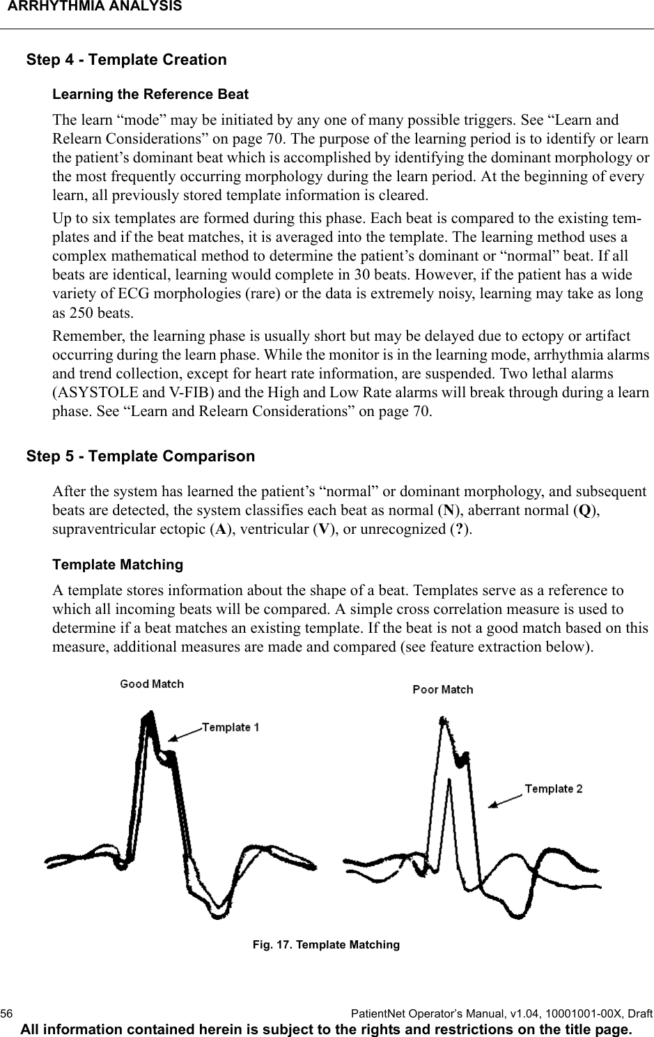 ARRHYTHMIA ANALYSIS56  PatientNet Operator’s Manual, v1.04, 10001001-00X, DraftAll information contained herein is subject to the rights and restrictions on the title page.Step 4 - Template CreationLearning the Reference BeatThe learn “mode” may be initiated by any one of many possible triggers. See “Learn and Relearn Considerations” on page 70. The purpose of the learning period is to identify or learn the patient’s dominant beat which is accomplished by identifying the dominant morphology or the most frequently occurring morphology during the learn period. At the beginning of every learn, all previously stored template information is cleared.Up to six templates are formed during this phase. Each beat is compared to the existing tem-plates and if the beat matches, it is averaged into the template. The learning method uses a complex mathematical method to determine the patient’s dominant or “normal” beat. If all beats are identical, learning would complete in 30 beats. However, if the patient has a wide variety of ECG morphologies (rare) or the data is extremely noisy, learning may take as long as 250 beats.Remember, the learning phase is usually short but may be delayed due to ectopy or artifact occurring during the learn phase. While the monitor is in the learning mode, arrhythmia alarms and trend collection, except for heart rate information, are suspended. Two lethal alarms (ASYSTOLE and V-FIB) and the High and Low Rate alarms will break through during a learn phase. See “Learn and Relearn Considerations” on page 70.Step 5 - Template ComparisonAfter the system has learned the patient’s “normal” or dominant morphology, and subsequent beats are detected, the system classifies each beat as normal (N), aberrant normal (Q), supraventricular ectopic (A), ventricular (V), or unrecognized (?). Template MatchingA template stores information about the shape of a beat. Templates serve as a reference to which all incoming beats will be compared. A simple cross correlation measure is used to determine if a beat matches an existing template. If the beat is not a good match based on this measure, additional measures are made and compared (see feature extraction below).Fig. 17. Template Matching