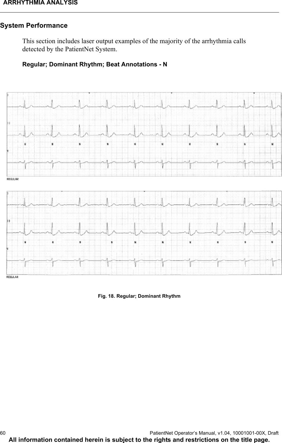 ARRHYTHMIA ANALYSIS60  PatientNet Operator’s Manual, v1.04, 10001001-00X, DraftAll information contained herein is subject to the rights and restrictions on the title page.System PerformanceThis section includes laser output examples of the majority of the arrhythmia calls detected by the PatientNet System.Regular; Dominant Rhythm; Beat Annotations - NFig. 18. Regular; Dominant Rhythm