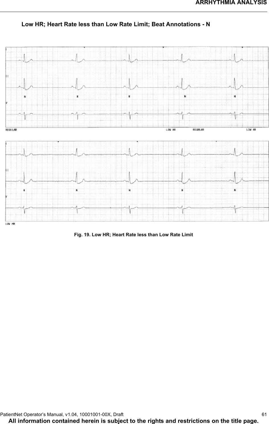 ARRHYTHMIA ANALYSISPatientNet Operator’s Manual, v1.04, 10001001-00X, Draft   61All information contained herein is subject to the rights and restrictions on the title page.Low HR; Heart Rate less than Low Rate Limit; Beat Annotations - NFig. 19. Low HR; Heart Rate less than Low Rate Limit